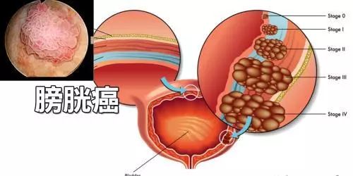 膀胱癌的病因是什么呢