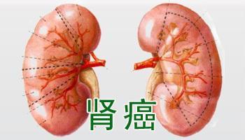 男性患肾癌病的常见原因是什么