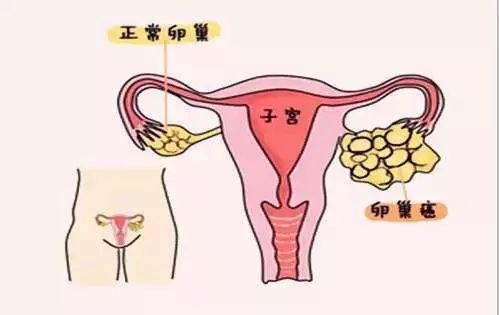 卵巢癌的危险因素是什么