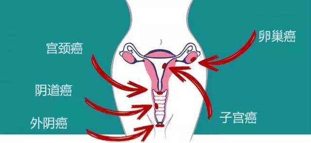 外阴癌的一些常见诱因