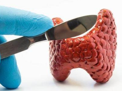 甲状腺癌的诱因
